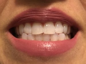 Review of Smile Brilliant's Teeth Whitening System